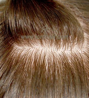 silicon injected hair replacement system